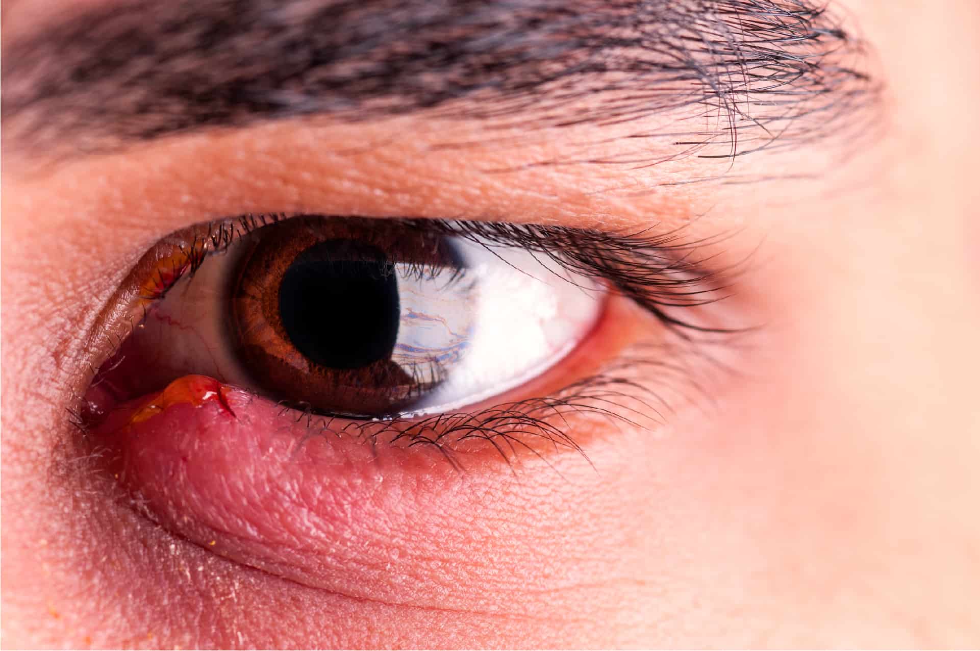 Sore Eyelids | Eye Health Library | BC Doctors of Optometry