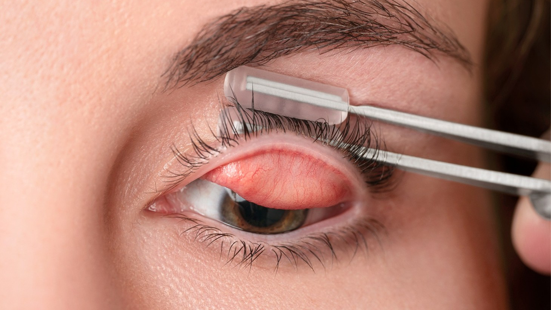 Cataract-CoManagement-Photoshop-Image Cataract-CoManagement-Photoshop-Image